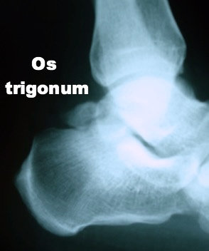 Resim 3: Arka ayakta sıkışmaya yol açan os trigonum.