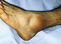 Ayak bileği burkulmasının tipik görünümü