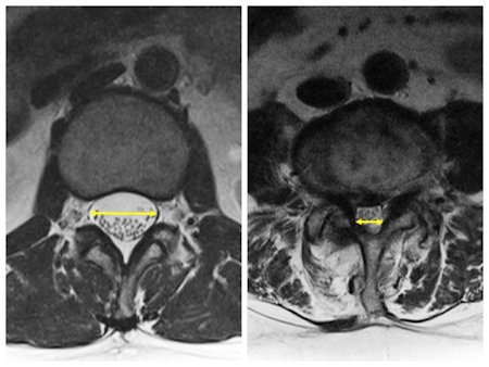 
Resim 3: Normal omurga kanalı ve dar kanalda MR kesitleri, oklar normal ve daralmış mesafeler arasındaki farkı gösteriyor.
