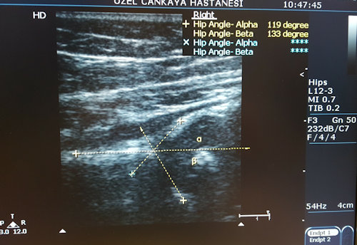 
Resim 2: Gelişme bozukluğu olan kalçaların ultrason görüntüleri.
