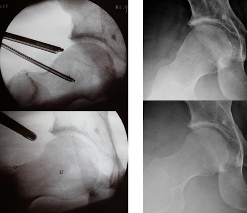 Resim 6: Sol tarafta ameliyat sırasındaki görüntüler, sağ tarafta röntgen görüntüleri izlenmektedir. Üstteki görüntülerde cam deformitesi, alttaki görüntülerde ise cam deformitesinin artroskopik tedavisinden sonra elde edilen normal kalça benzeri görüntüler izlenmektedir.   
