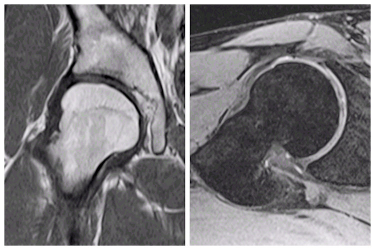 
Resim 3: Kalça displazisi olan hastanın manyetik rezonans görüntüleme (MRG) ile değerlendirilmesi.
