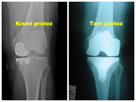
Resim 1: Solda kısmi protez, sağda tam protez uygulanmış hastaların röntgen görüntüleri.
