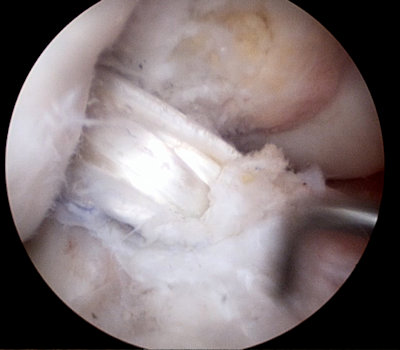 Resim 1: Artroskopik ön çapraz bağ onarımı sonunda bağın yerine yerleştirilen hamstring tendonlarının görünümü.