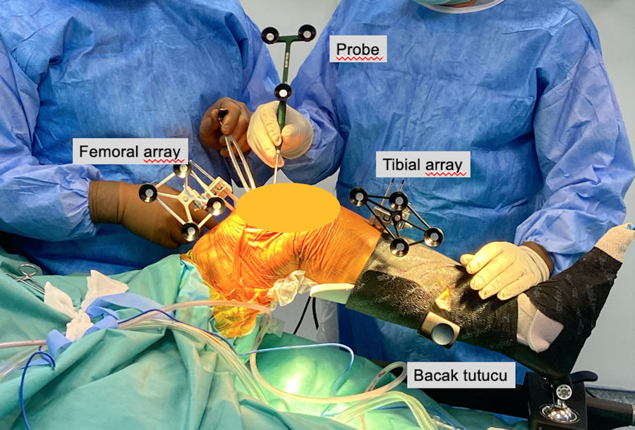 Resim 3: Robotik cerrahinin en önemli avantajı, hastanın bağlarını gevşetmeden mükemmel bir yumuşak doku dengesi sağlamasıdır